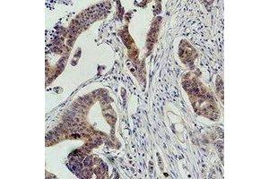 Immunohistochemical analysis of c-RAF staining in human colon cancer formalin fixed paraffin embedded tissue section. (RAF1 antibody)