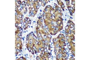 Immunohistochemistry of paraffin-embedded Human liver cancer using [KO Validated] NSDHL Rabbit pAb (ABIN7268794) at dilution of 1:100 (40x lens). (NSDHL antibody  (AA 1-240))