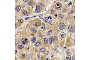 Immunohistochemical analysis of ATP5B staining in human liver cancer formalin fixed paraffin embedded tissue section. (ATP5B antibody)