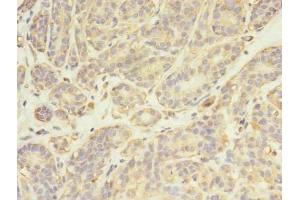 Immunohistochemistry of paraffin-embedded human breast cancer using ABIN7174025 at dilution of 1:100 (FYN antibody  (AA 154-270))