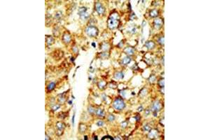 Formalin-fixed and paraffin-embedded human cancer tissue reacted with the primary antibody, which was peroxidase-conjugated to the secondary antibody, followed by DAB staining. (SETD8 antibody  (N-Term))