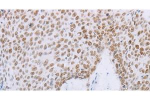 Immunohistochemistry of paraffin-embedded Human lung cancer tissue using MCM2 Polyclonal Antibody at dilution 1:50 (MCM2 antibody)