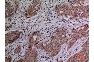 Immunohistochemical analysis of paraffin-embedded human-breast-cancer, antibody was diluted at 1:100. (IL-4 antibody  (Internal Region))