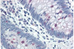 Human Colon (formalin-fixed, paraffin-embedded) stained with STAT5A/STAT5B antibody ABIN337157 at 20-40 ug/ml followed by biotinylated goat anti-rabbit IgG secondary antibody ABIN481713, alkaline phosphatase-streptavidin and chromogen. (STAT5 A/B antibody  (pTyr694))