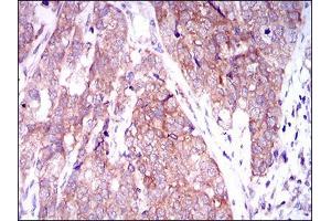 Immunohistochemical analysis of paraffin-embedded bladder cancer tissues using MARK3 mouse mAb with DAB staining. (MARK3 antibody  (AA 435-658))