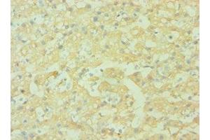 Immunohistochemistry of paraffin-embedded human liver cancer using ABIN7143440 at dilution of 1:100 (CD38 antibody  (AA 75-300))