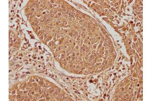 IHC image of ABIN7156695 diluted at 1:600 and staining in paraffin-embedded human cervical cancer performed on a Leica BondTM system. (EIF2AK2 antibody  (AA 90-358))