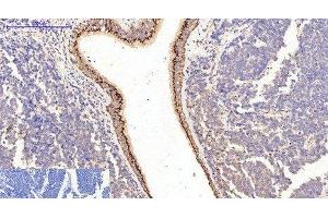 Immunohistochemistry of paraffin-embedded Human lung cancer tissue using COL1A1 Monoclonal Antibody at dilution of 1:200. (COL1A1 antibody)
