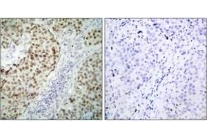 Immunohistochemistry (IHC) image for anti-Tumor Protein P53 (TP53) (AA 1-50) antibody (ABIN2889047) (p53 antibody  (AA 1-50))