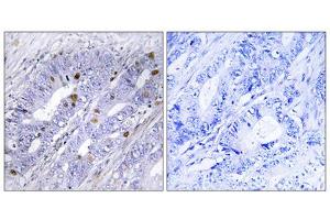 Immunohistochemistry analysis of paraffin-embedded human colon carcinoma tissue using Nuclear Receptor NR4A1 (epitope around residue 351) antibody. (NR4A1 antibody  (Ser351))