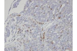 IHC-P Image Immunohistochemical analysis of paraffin-embedded human serous ovarian cancer, using ST3GAL1, antibody at 1:100 dilution. (ST3GAL1 antibody)