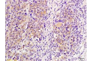 Formalin-fixed and paraffin embedded mouse lymphoma labeled with Anti-IL-21R Polyclonal Antibody, Unconjugated (ABIN748148) at 1:200 followed by conjugation to the secondary antibody and DAB staining (IL21 Receptor antibody  (AA 441-538))