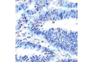 Immunohistochemistry of paraffin-embedded human colon carcinoma using PTBP1 Rabbit mAb (ABIN7269464) at dilution of 1:100 (40x lens). (PTBP1 antibody)
