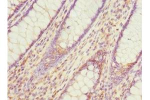 Immunohistochemistry of paraffin-embedded human colon cancer using ABIN7164695 at dilution of 1:100 (PDCD5 antibody  (AA 1-125))