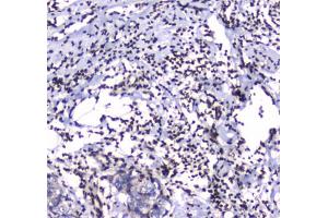 IHC testing of FFPE human breast cancer tissue with GFI1 antibody at 1ug/ml. (GFI1 antibody)