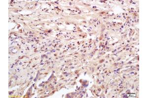 Formalin-fixed and paraffin embedded human colon carcinoma labeled with Anti-Phospho-MAPKAPK2 (Thr222) Polyclonal Antibody, Unconjugated (ABIN743678) at 1:200 followed by conjugation to the secondary antibody and DAB staining (MAPKAP Kinase 2 antibody  (pThr222))