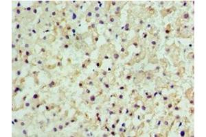 Immunohistochemistry of paraffin-embedded human liver cancer using ABIN7147368 at dilution of 1:100 (CENPQ antibody  (AA 131-268))