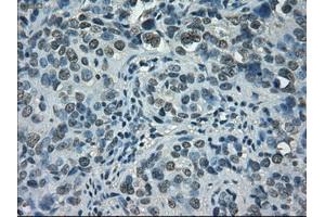 Immunohistochemical staining of paraffin-embedded Carcinoma of bladder tissue using anti-STAT1mouse monoclonal antibody. (STAT1 antibody)