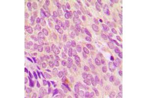 Immunohistochemical analysis of SDCCAG8 staining in human breast cancer formalin fixed paraffin embedded tissue section. (SDCCAG8 antibody  (C-Term))