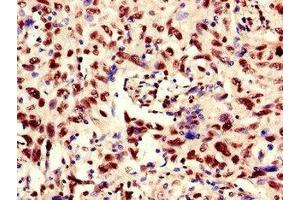 Immunohistochemistry of paraffin-embedded human lung cancer using ABIN7168329 at dilution of 1:100 (RNA Binding Motif Protein, Y Chromosome (RBMY) (AA 501-700) antibody)