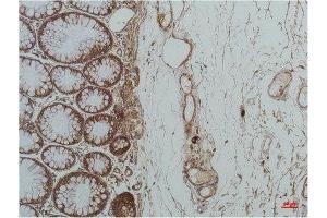 Immunohistochemistry (IHC) analysis of paraffin-embedded Human Colon Carcicnoma using GRP78/Bip Mouse Monoclonal Antibody diluted at 1:200. (GRP78 antibody)