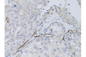 Immunohistochemistry of paraffin-embedded human breast cancer using CD34 antibody (ABIN1871618) at dilution of 1:50 (40x lens). (CD34 antibody)