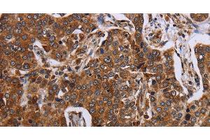 Immunohistochemistry of paraffin-embedded Human liver cancer using ACP6 Polyclonal Antibody at dilution of 1:30 (ACP6 antibody)