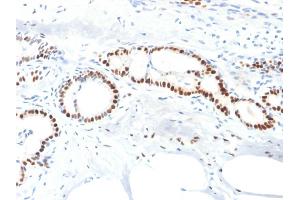 Formalin-fixed, paraffin-embedded human Breast Carcinoma stained with Estrogen Receptor alpha Mouse Monoclonal Antibody (ESR1/1904). (Estrogen Receptor alpha antibody)