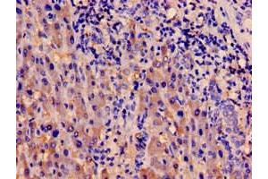 Immunohistochemistry of paraffin-embedded human liver cancer using ABIN7142002 at dilution of 1:100 (PDPK1 antibody  (AA 294-432))