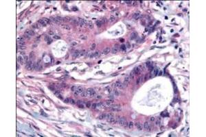 Affinity Purified Plk1 pT210 was used at a 1:200 dilution to detect Plk1 by immunohistochemistry in human colon carcinoma tumor tissue. (PLK1 antibody  (pThr210))