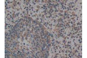 Detection of GLG1 in Human Skin cancer Tissue using Polyclonal Antibody to Golgi Glycoprotein 1 (GLG1) (GLG1 antibody  (AA 1048-1145))