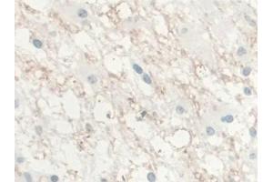 IHC-P analysis of Human Glioma Tissue, with DAB staining. (IL-10 antibody  (AA 1-178))