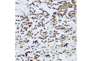 Immunohistochemistry of paraffin-embedded human lung cancer using PIKFYVE antibody (ABIN5974035) at dilution of 1/100 (40x lens). (PIKFYVE antibody)