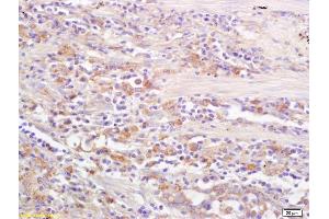 Formalin-fixed and paraffin embedded human lung carcinoma labeled with Rabbit Anti CD69/CLEC2C/AIM Polyclonal Antibody, Unconjugated (ABIN741150) at 1:200 followed by conjugation to the secondary antibody and DAB staining (CD69 antibody  (AA 101-199))