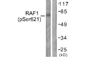Immunohistochemistry analysis of paraffin-embedded human lung carcinoma tissue using Raf1 (Phospho-Ser621) antibody. (RAF1 antibody  (pSer621))