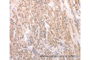 Immunohistochemistry of Human esophagus cancer using ACIN1 Polyclonal Antibody at dilution of 1:80 (ACIN1 antibody)