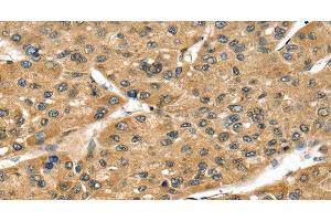 Immunohistochemistry of paraffin-embedded Human liver cancer tissue using STX8 Polyclonal Antibody at dilution 1:45 (STX8 antibody)