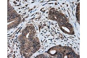 Immunohistochemical staining of paraffin-embedded Adenocarcinoma of colon tissue using anti-MTRF1L mouse monoclonal antibody. (MTRF1L antibody)