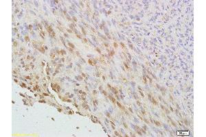 Formalin-fixed and paraffin embedded human cervical carcinoma labeled with Anti phospho-CDKN1A/P21 (Thr145) Polyclonal Antibody, Unconjugated  at 1:200 followed by conjugation to the secondary antibody and DAB staining (p21 antibody  (pThr145))
