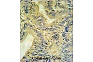 LXN Antibody IHC analysis in formalin fixed and paraffin embedded colon carcinoma followed by peroxidase conjugation of the secondary antibody and DAB staining. (Latexin antibody)
