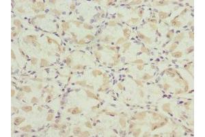 Immunohistochemistry of paraffin-embedded human gastric cancer using ABIN7165131 at dilution of 1:100 (Nerve Growth Factor Receptor (TNFRSF16) Associated Protein 1 (NGFRAP1) (AA 1-111) antibody)