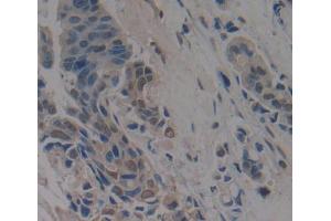 IHC-P analysis of breast cancer tissue, with DAB staining. (Anoctamin 2 antibody  (AA 823-1003))