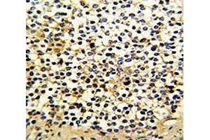 IHC analysis of FFPE human kidney carcinoma with DCXR antibody (DCXR antibody  (AA 79-106))