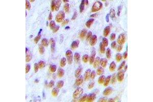 Immunohistochemical analysis of KDM1A staining in human breast cancer formalin fixed paraffin embedded tissue section. (LSD1 antibody)