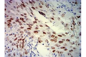 Immunohistochemical analysis of paraffin-embedded lung cancer tissues using MSH6 mouse mAb with DAB staining. (MSH6 antibody  (AA 374-540))