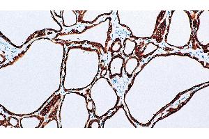 Thyroid, Graves' disease: immunohistochemical staining for Thyroid Peroxidase. (Thyroperoxidase antibody  (N-Term))