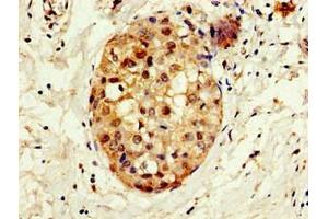 Immunohistochemistry of paraffin-embedded human breast cancer using ABIN7148671 at dilution of 1:100 (CBP antibody  (AA 2217-2442))