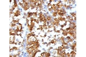 Formalin-fixed, paraffin-embedded human melanoma stained with MART-1 antibody (SPM540). (Recombinant MLANA antibody)