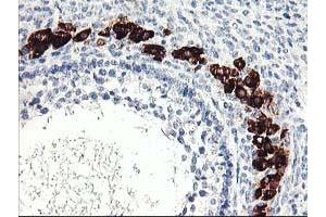 Immunohistochemical staining of paraffin-embedded Adenocarcinoma of Human ovary tissue using anti-PTPN7 mouse monoclonal antibody. (PTPN7 antibody)