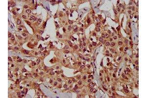 IHC image of ABIN7146680 diluted at 1:300 and staining in paraffin-embedded human liver cancer performed on a Leica BondTM system. (CHST11 antibody  (AA 214-330))